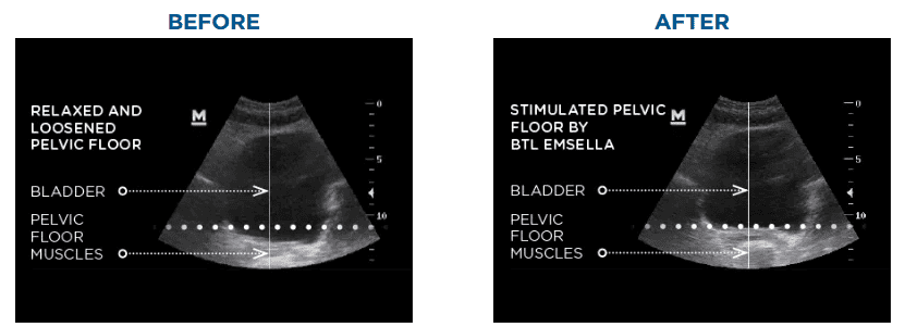 Before and After Pelvic Floor Ultrasound Scan