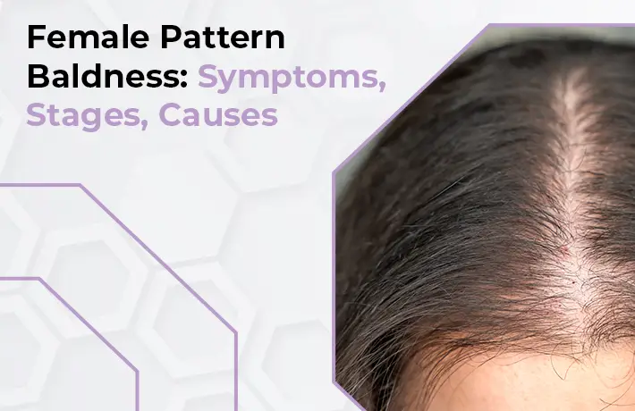 Female Pattern Baldness: Symptoms, Stages, Causes