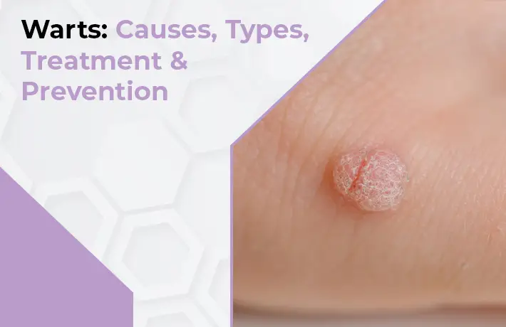 Warts: Causes, Types, Treatment & Prevention