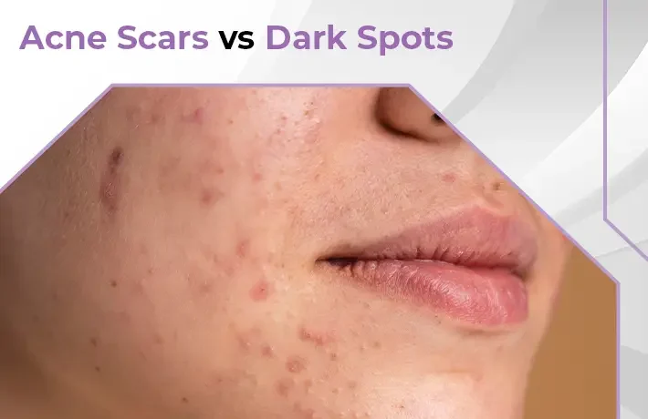 Acne Scars vs. Dark Spots