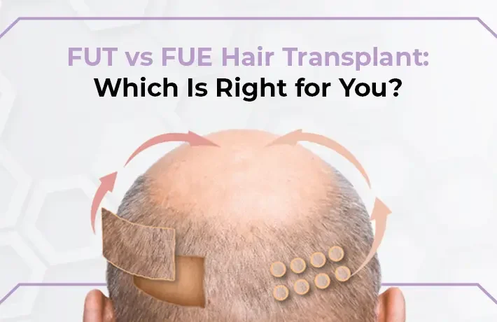 FUT vs FUE Hair Transplant: Which Is Right for You?