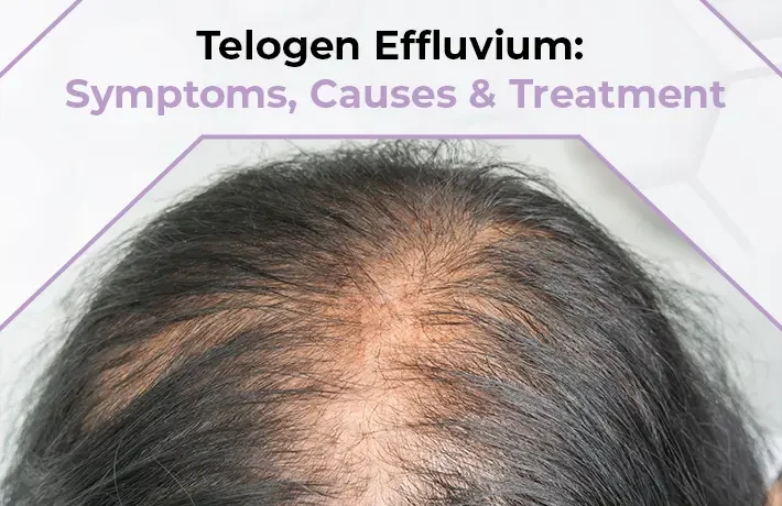 Telogen Effluvium: Symptoms, Causes & Treatment