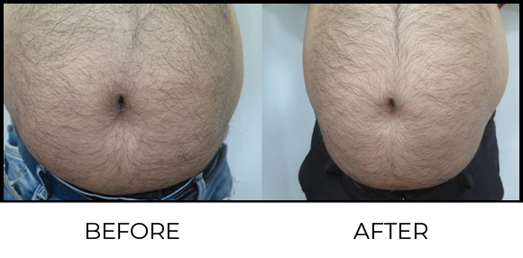 Coolsculpting Before & After 1