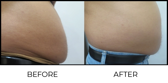 Coolsculpting Before & After 2