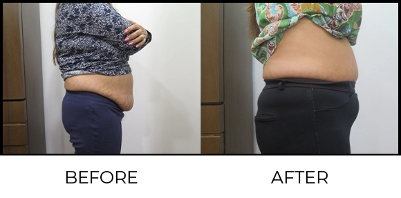Coolsculpting Before & After 3