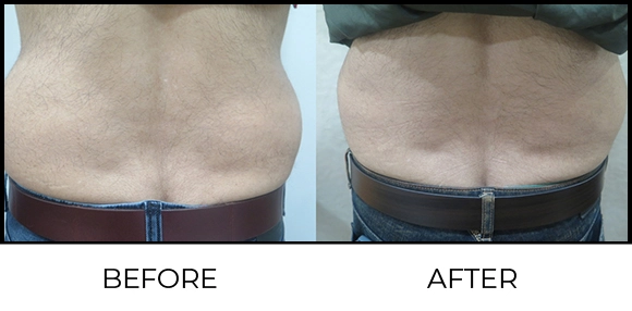 Coolsculpting Before & After 4