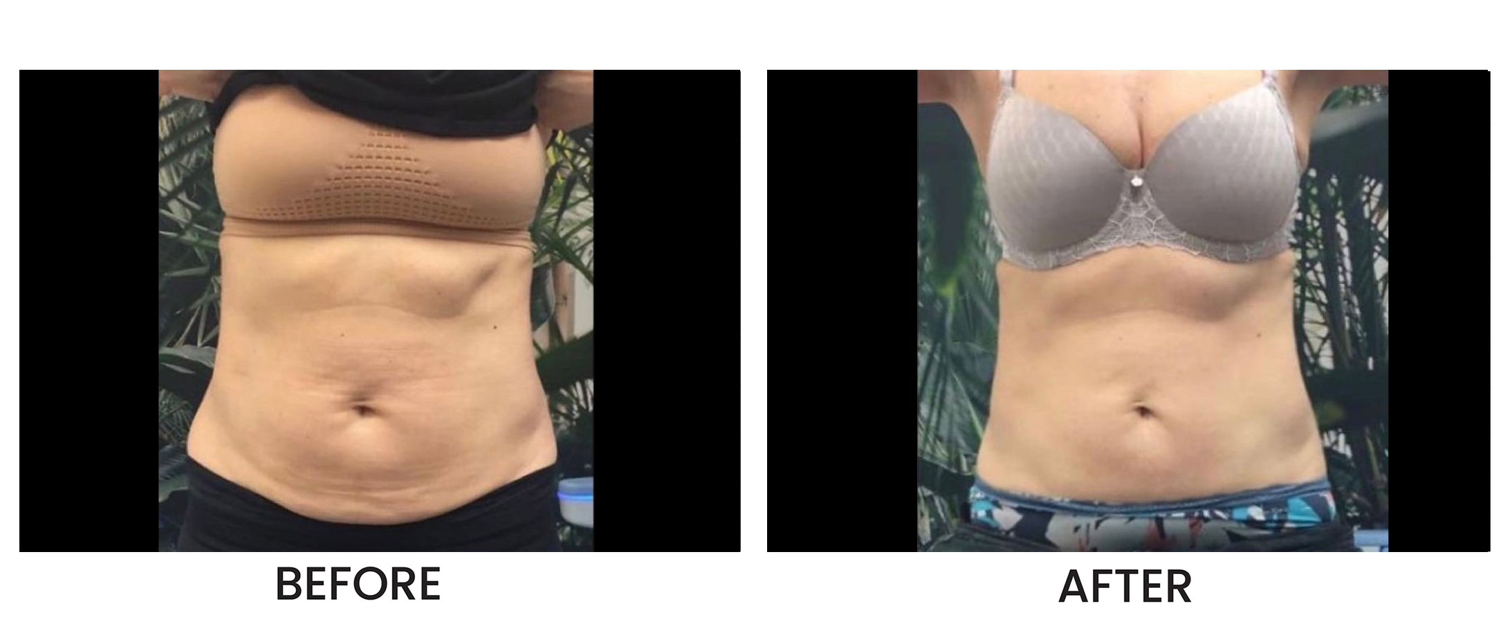 Emerald Laser Before & After 1
