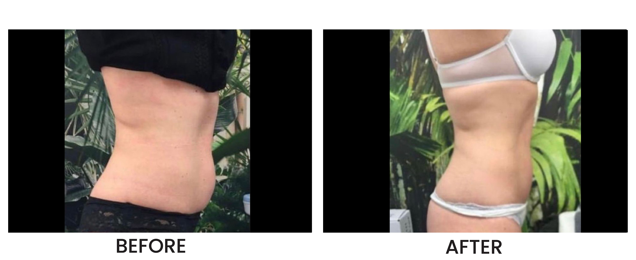 Emerald Laser Before & After 2