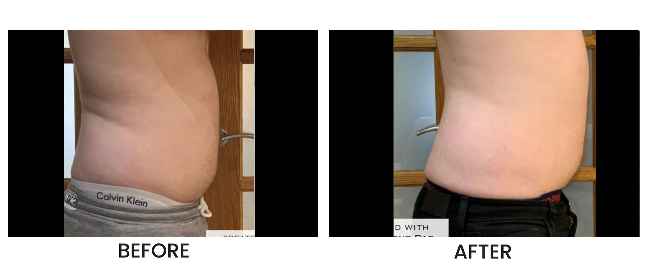 Emerald Laser Before & After 3