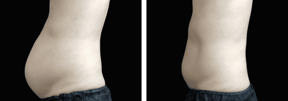Abdomen Before After 1