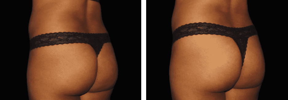 Thighs Before After 5