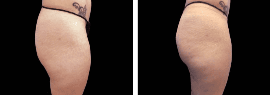 Thighs Before After 6