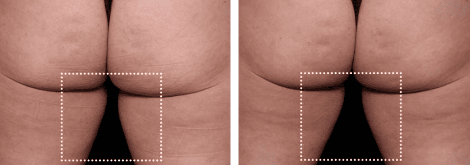 Buttocks Before After 2