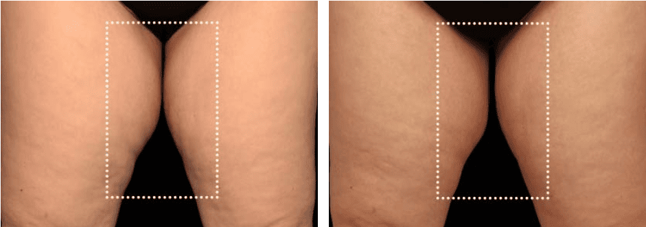 Buttocks Before After 3