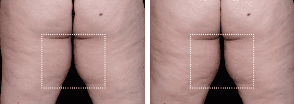 Buttocks Before After 4