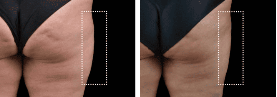 Buttocks Before After 5