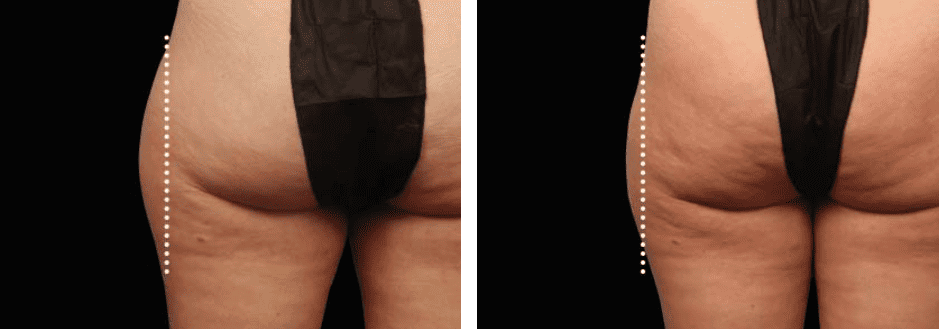 Buttocks Before After 6