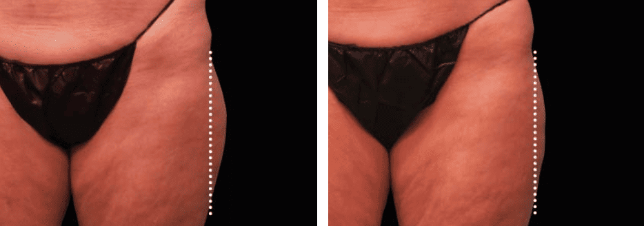 Buttocks Before After 1