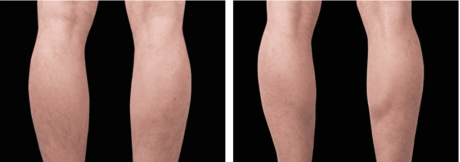 Arms Before After 1