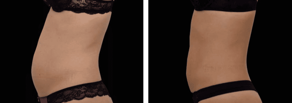 Abdomen Before After 2