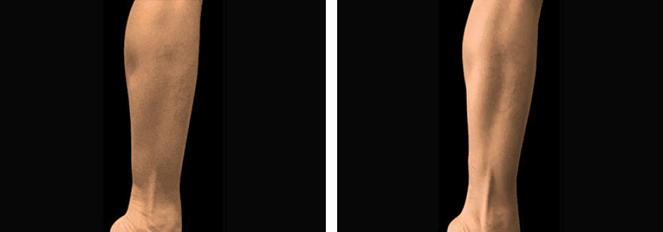 Arms Before After 2