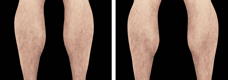Arms Before After 3