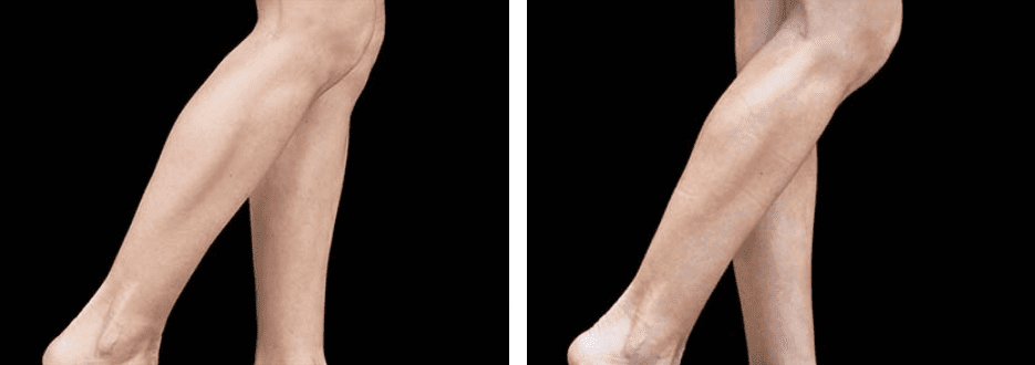 Arms Before After 4