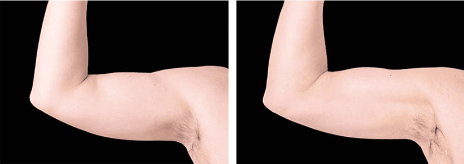 Flanks Before After 1