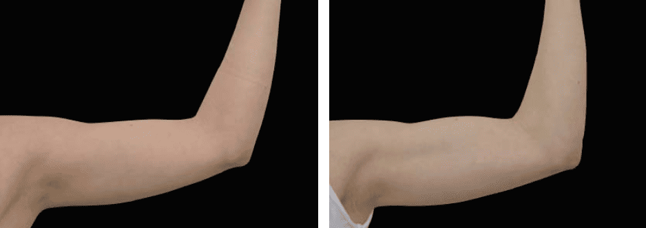 Flanks Before After 2