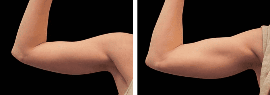 Flanks Before After 4
