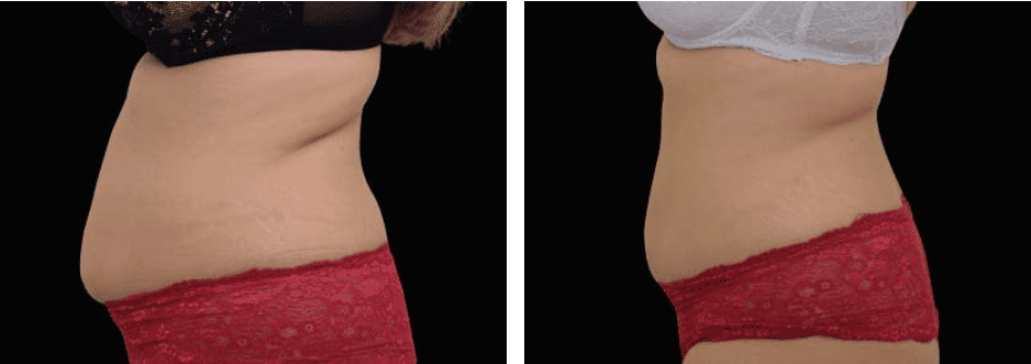 Abdomen Before After 3