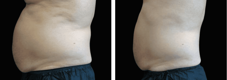 Abdomen Before After 4