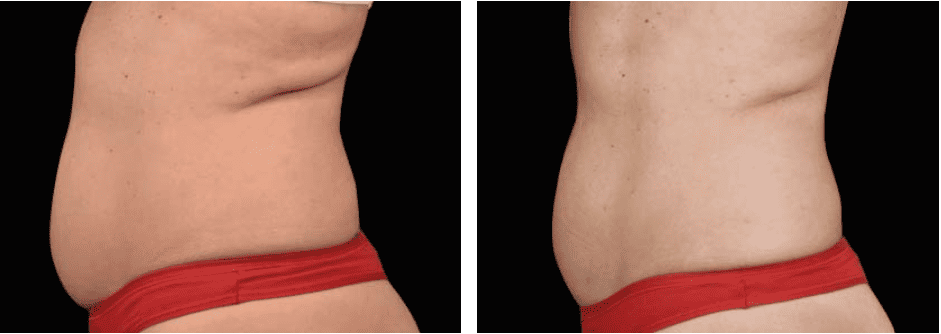Abdomen Before After 5