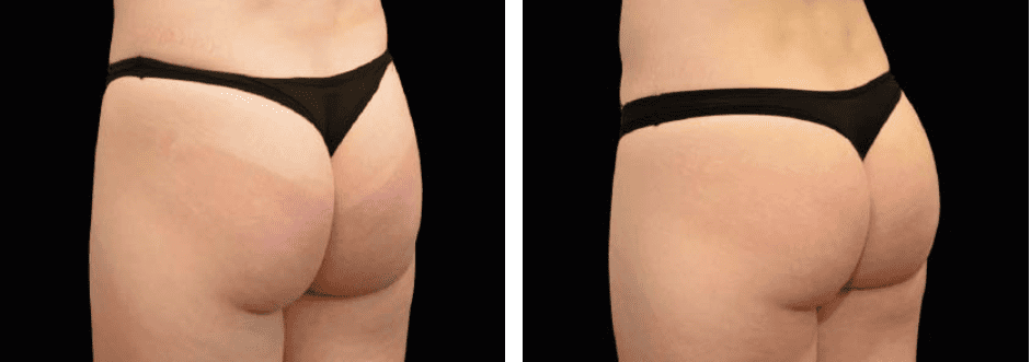Thighs Before After 1