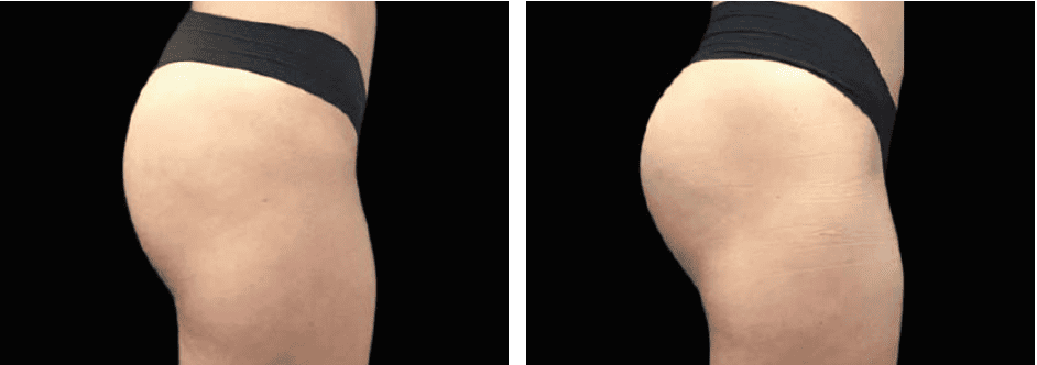 Thighs Before After 2