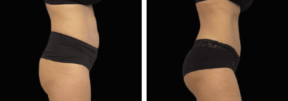 Thighs Before After 3