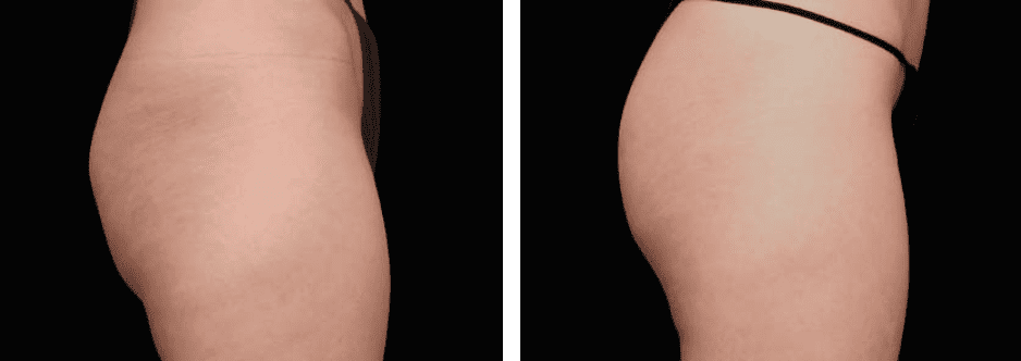 Thighs Before After 4