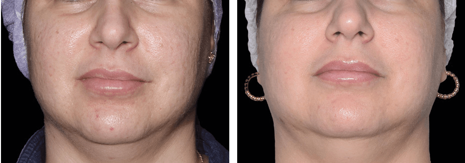 Face Before After 4