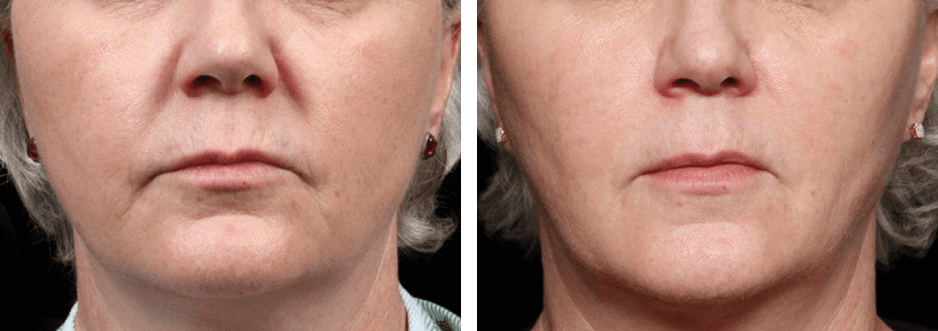 Neck Before After 1