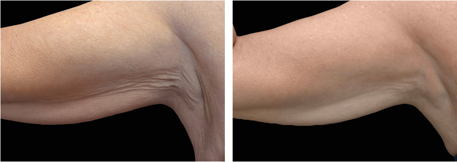 Body Before After 1