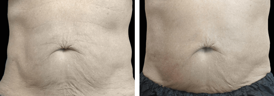 Arms Before After 1