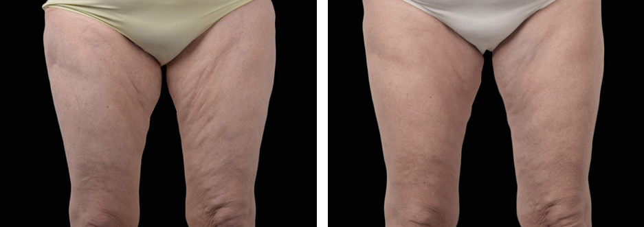 Intimate Before After 1