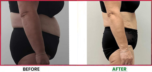Body Sculpting Before & After 1