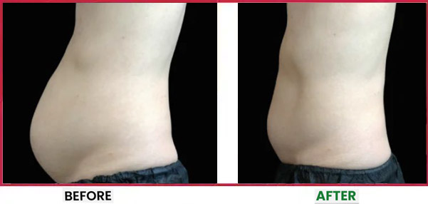 Body Sculpting Before & After 10