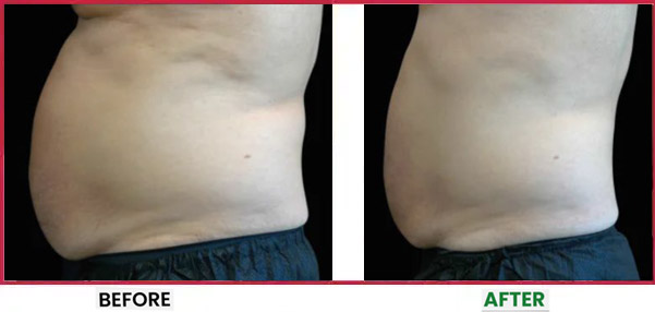 Body Sculpting Before & After 11