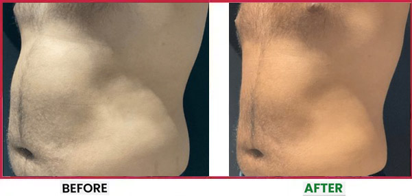 Body Sculpting Before & After 2