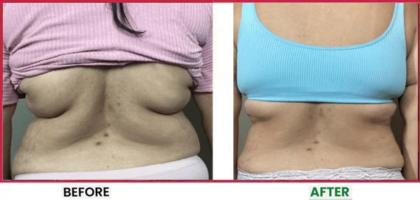Body Sculpting Before & After 3