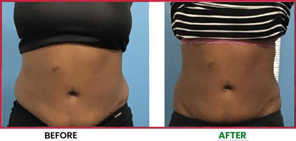 Body Sculpting Before & After 4