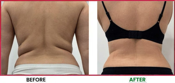 Body Sculpting Before & After 5
