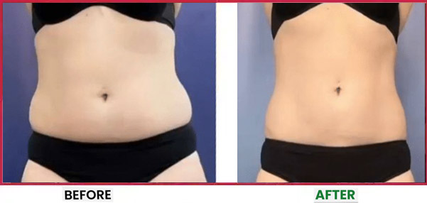 Body Sculpting Before & After 6